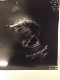 6 Week 3 Days Scan Showed Nothing But Small Gestational Sac Netmums