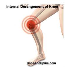 Internal Derangement Of Knee Causes And Treatment Bone And Spine