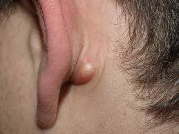 Causes include bacteria such as e. Alternatives To Popping A Cyst At Home Face Back And Neck