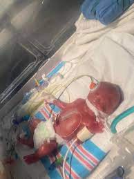 Jenny Trujillo posted to one of the PPROM support groups due to the fact that her water had broken at 20 weeks pregnant. The first hospital she went to basically told her
