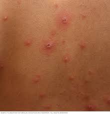 Try soft, gentle foods such as warm soup, oatmeal, pudding, or ice cream. Chickenpox Symptoms And Causes Mayo Clinic
