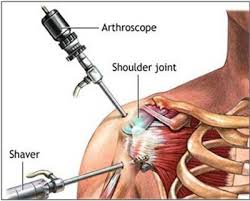 Progressive injuries are most often associated with work (such as painting or lifting) or sports. Due To His Self Confidence In The Capability To Repair The Rotator Cuff In A Steady Fas Rotator Cuff Surgery Shoulder Arthroscopy Arthroscopic Shoulder Surgery