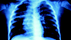 If there's reason to think that you may have lung cancer, your doctor can order a number of tests to look for cancerous cells and to rule out other conditions. Chest X Rays Miss Lung Cancer In Almost A Quarter Of Cases Roy Castle Lung Cancer Foundation