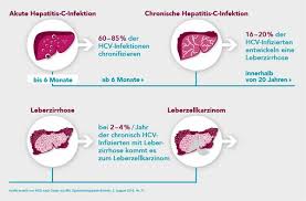Hepatitis means inflammation of the liver. Hepatitis C Hcv Msd