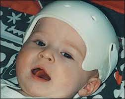 Image result for Positional Head Deformity