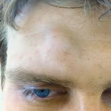 Und obwohl ich bei meiner pflege (ich creme das gesicht nicht ein) nichts geändert habe, habe ich seit einer woche jede. Lipom Liposarkom Ursache Symptome Diagnose Entfernung