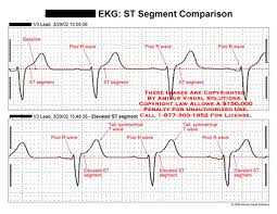 Amicus Illustration Of Amicus Chart Ekg Ecg St Segment