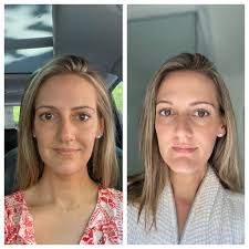You should expect to see results in three to four days, but in as few as two and as many as five days. First Time Botox What To Expect Q A See Anna Jane
