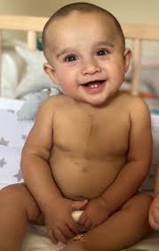 His name is Samuel. He was diagnosed with Alagille Ayndrome at 3 months old  and has had many procedures done. His biggest scar is from his open heart  surgery for TOF. We