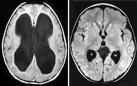 Image result for Hydrocephalus