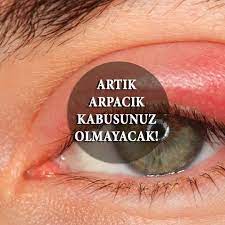 Artik Arpacik Kabusunuz Olmayacak Goz Kapaginda Cikan Iltihapli Sivilcedir Goz Kapagi Kenarinin Kizar Masiyla