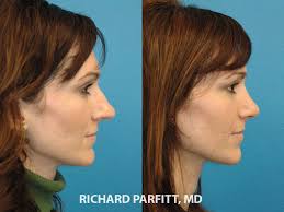 We did not find results for: Rhinoplasty Before And After Photos Dr Richard Parfitt