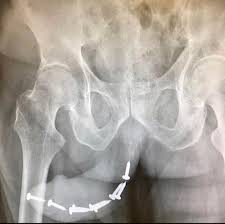 When one screw isnt enough. Theres 9. Male urethra : rRadiology