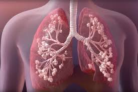 What causes cystic fibrosis and how is cystic fibrosis inherited? Discovery Could Help Improve Cystic Fibrosis Treatment Berkeley News