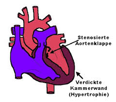 Case discussion aortopulmonary window , (partial truncus arteriosus or aortopulmonary septal defect ) is a rare congenital conotruncal cardiac anomaly with communication between the ascending aorta & the main or right pulmonary artery. Subaortenstenose Sas Und Aortenstenose Besitzerinformationen Der Tierkardiologie Universitat Munchen