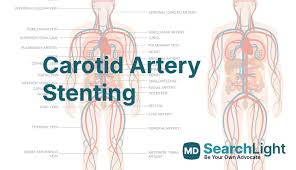 Image result for carotid artery