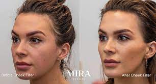 Everything you need to know about injections for sculpted. Cheek Fillers Perth Cheek Injections Mira Clinic