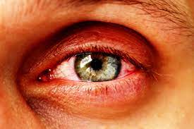 Augeninfarkt Ursachen Symptome Und Therapie Heilpraxis