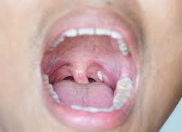 We did not find results for: Easy Tips To Heal From Tonsil Stones Women S Feature Service