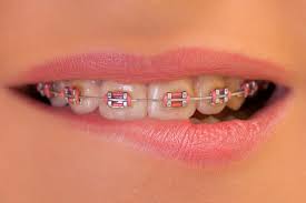 According to a 2018 survey by the american dental association, the average cost of braces for children, regardless. What To Expect When Getting Braces On Top Teeth Only Fine Orthodontics Blogfine Orthodontics Blog