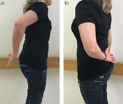 Image result for Lift-Off Subscapularis Test