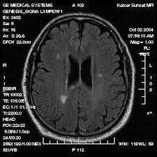 We did not find results for: Scleroza Multipla Sm Neurologie