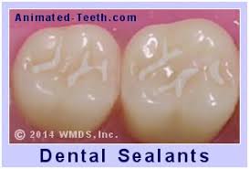 As caries risk may increase due to. The Dental Sealant Procedure How Tooth Sealants Are Placed Animated Teeth Com