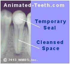 The main effect of the root canal treatment is that it leads to weakening. What To Expect After Root Canal Treatment Post Op Pain Aftercare Precautions