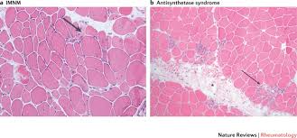 Image result for Polymyositis
