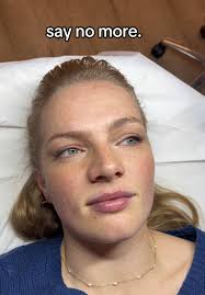 Expert Lip Filler Transformation for New Clients