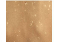 Image result for Postinflammatory Hypopigmentation