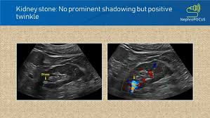 Image result for Nephrolithiasis Imaging