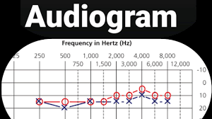 An audiogram is a hearing test that measures the softest sound you can. How To Read Audiogram Tympanogram Basic Things About Audiogram Youtube