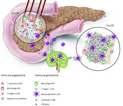 How is pancreatic cancer diagnosed? Ire Stimulates The Immune Response To Pancreatic Cancer