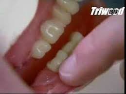 Do it your self dental impression kit. Making Dentures Youtube