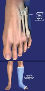 A jones fracture is a break involving the base of the 5th metatarsal bone. Jones Fractures Central Coast Orthopedic Medical Group