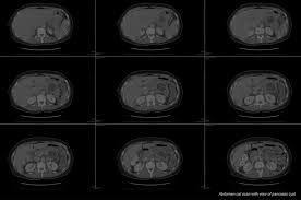 South texas pancreatic cancer screening service. Pancreatic Cancer Onglyza Lawsuit Diabetes Drugs Impact Law