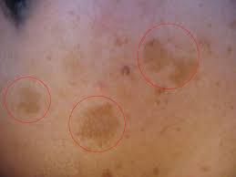 Hyperpigmentierung Braune Hautverfarbungen Ursachen Entfernung