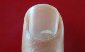 White Spots Fingernail Leukonychia Punctata White Patches On Toenails White Spots On Nails White Spots On Toenails Toenail Fungus Treatment