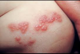 Herpes is a virus with multiple strains; Pictures Of Viral Skin Diseases And Problems Herpes Zoster