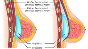 Brustkrebs Klassifikation Dkg