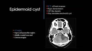 Posterior Fossa