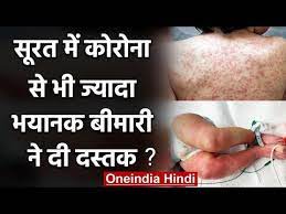 Gujarat के Surat में क्या Coronavirus से भी ज्यादा भयानक बीमारी आई सामने ?  | वनइंडिया हिंदी - YouTube