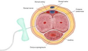 Image result for Priapism