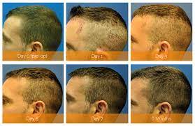 Working From Home Do I Need Time Off For My Hair Transplant Recovery Nashville Hair Doctor