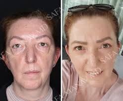 Premium Facelift Surgery with European Board-Certified Doctor Ali Sadioglu