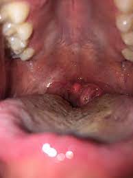 Brown Spot On My Tonsil I Feel Like Something Is Stuck In My Throat On That Side Possible Tonsil Stone Please Help More Info In Comments Popping