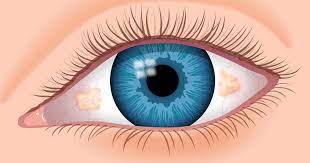 What Is A Pinguecula Dry Eye Symptoms Eye Infections Blepharitis