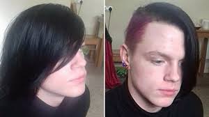 It is considered an autoimmune condition that results in inflammation and loss of hair. A Teenage Boy Was Suspended From School For His Dyed Undercut Allure