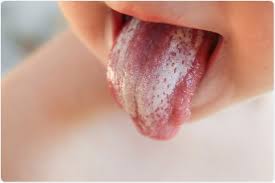 Image result for oral thrush symptoms roof of the mouth